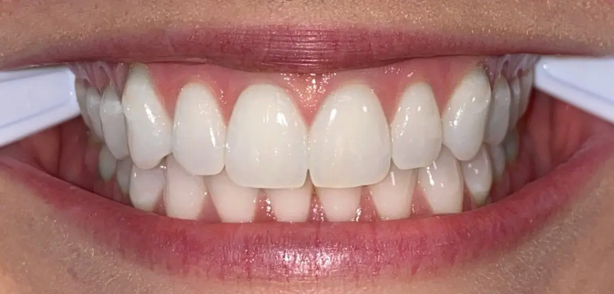 A close-up of a smile reveals clean, white teeth and healthy gums, expertly maintained at Freelove Orthodontics. Lip retractors are used to keep the mouth open in Kent and Sammamish, WA