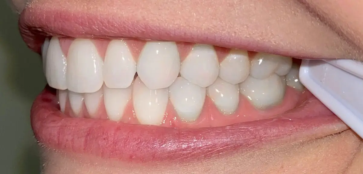 Close-up of a person's smile showcasing clean, aligned teeth, thanks to Freelove Orthodontics. A dental instrument is seen on the right side of the mout in Kent and Sammamish, WA