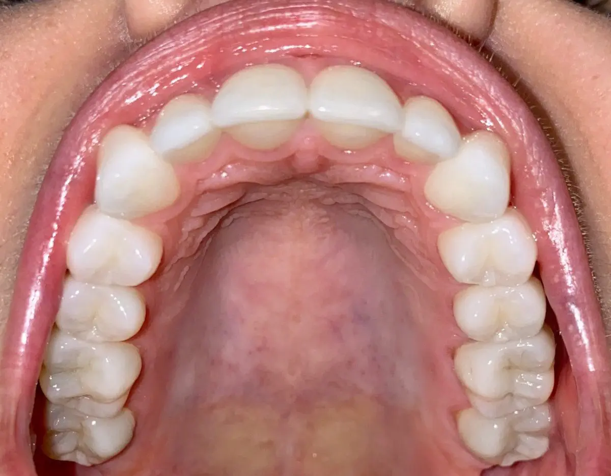 Close-up of an open mouth showcasing the precision care by Freelove Orthodontics, highlighting an upper row of teeth, gums, and the roof of the mouth in Kent and Sammamish, WA