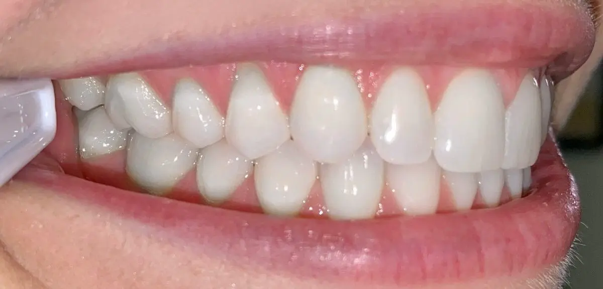 Close-up of a person's clean, aligned teeth with clear braces on the lower teeth, displayed in a dental retractor at Freelove Orthodontics in Kent and Sammamish, WA