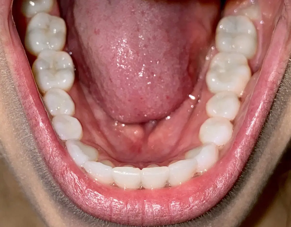 Open mouth showing a clear view of the bottom row of teeth and tongue, with several dental features like the molars and gums in full display, courtesy of expert care at Freelove Orthodontics in Kent and Sammamish, WA