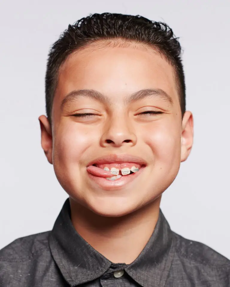 What To Expect From Your First Week In Braces