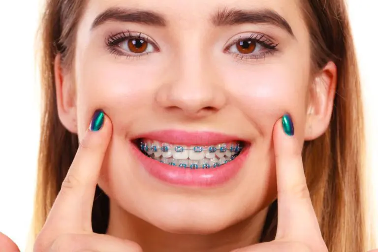 Braces Kent