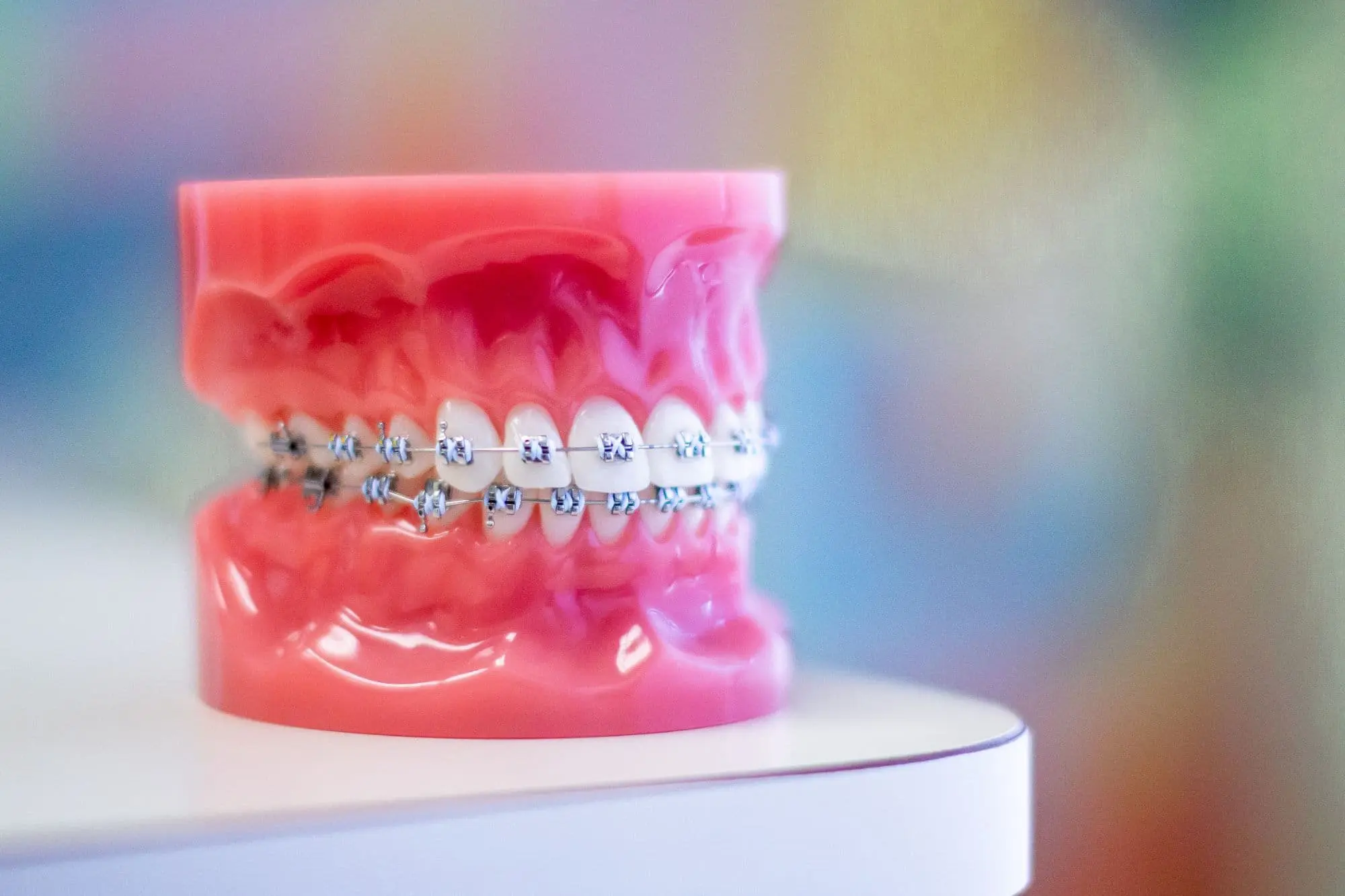 braces in Sammamish and Kent WA to treat overbite