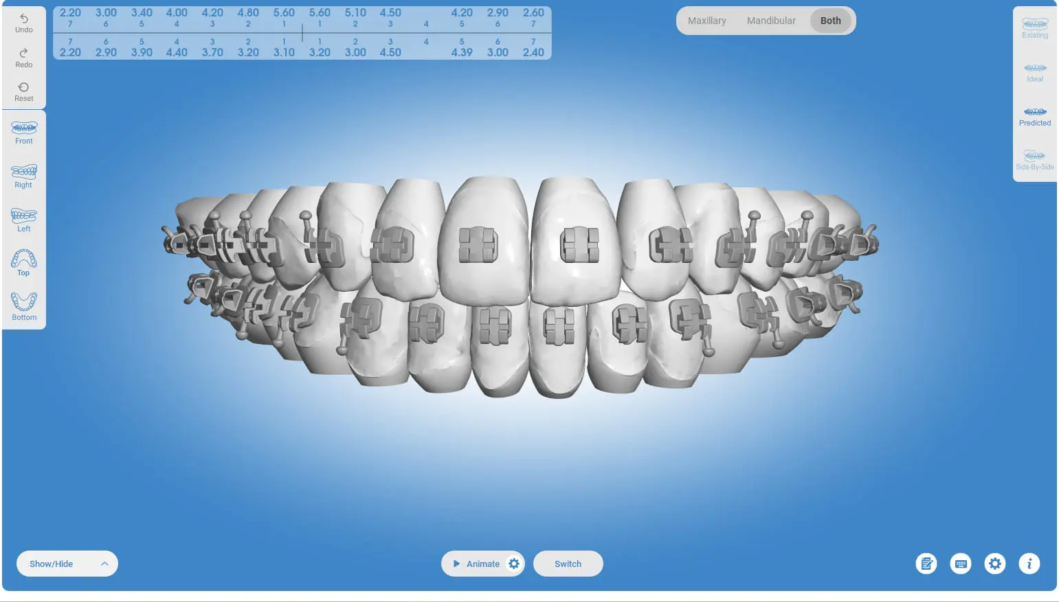 Digital rendering of human teeth with orthodontic braces, displayed in a frontal view on a blue background in Sammamish, WA
