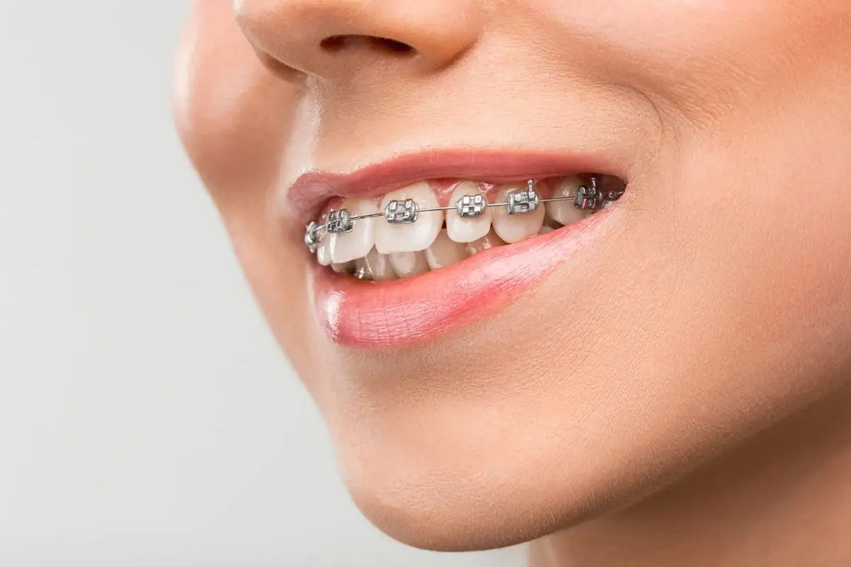 A close-up of an overbite person smiling, showing metal braces from orthodontist in Sammamish and Kent, WA on their teeth.
