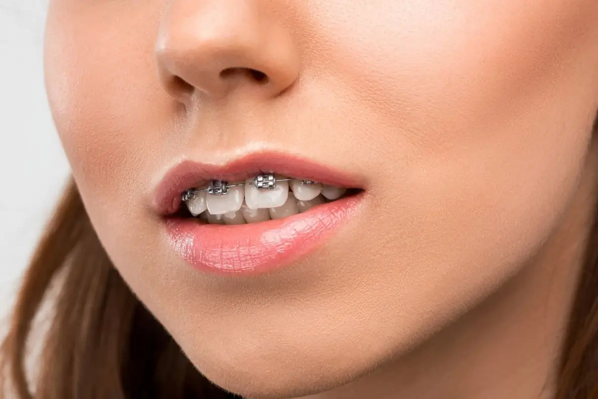 Close-up of a woman's lips and teeth, highlighting metal braces working to correct her overbite, with a soft focus on the skin and lips in Sammamish or Kent, WA.