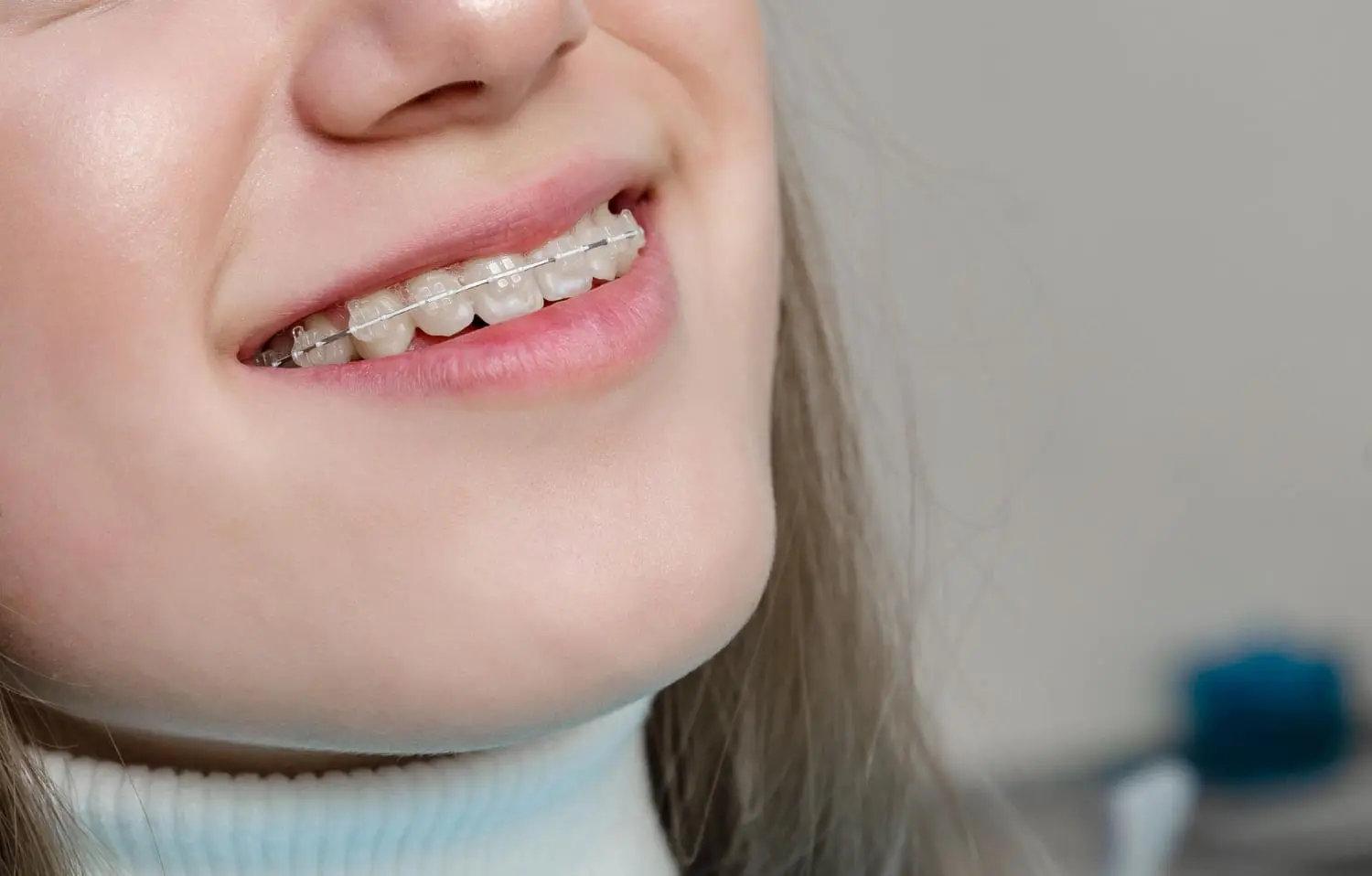 Close-up of a person smiling, showing teeth with clear braces. Illustrating adult braces in Sammamish and Kent, WA