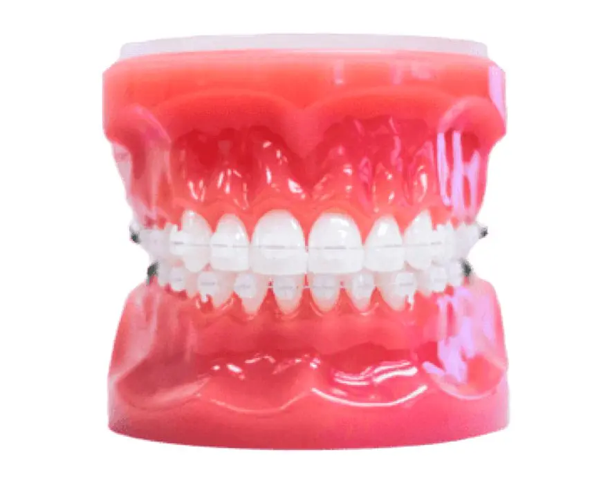 Best Orthodontics A dental model displays a complete set of upper and lower teeth equipped with clear braces, all resting on a pink gum base in Sammamish or Kent, WA