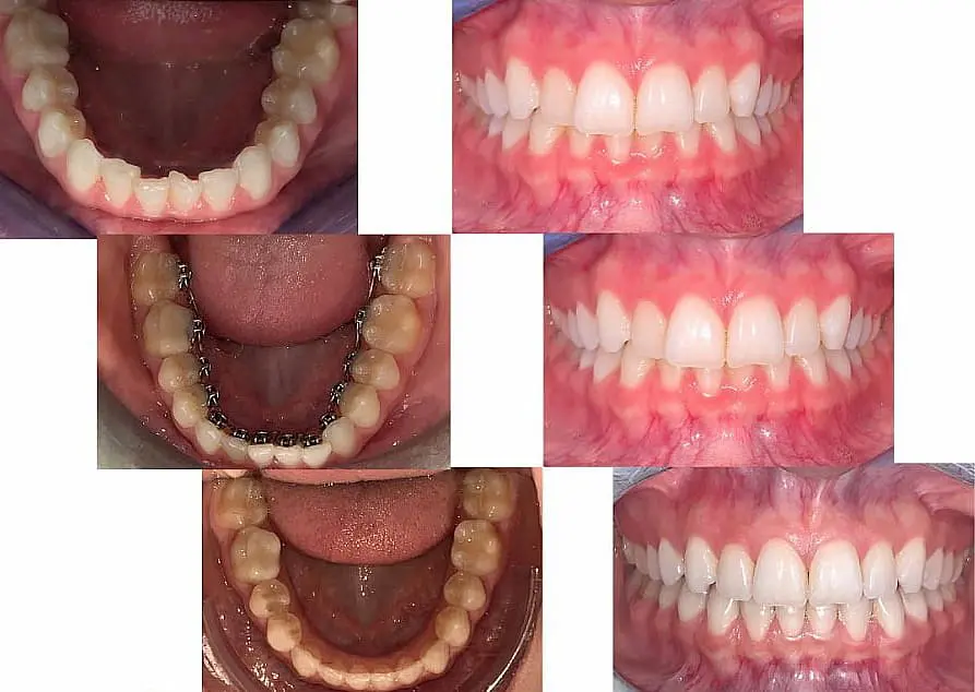 Collage of nine dental images showcasing various views of teeth and gums, including close-ups of braces on lower teeth, and before and after shots revealing the transformative effect of lingual braces in Sammamish and Kent, WA