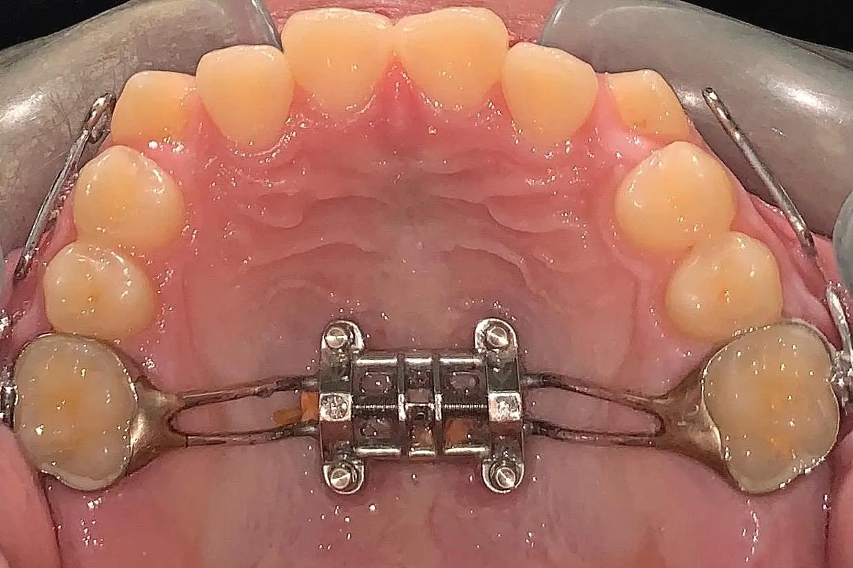 A top view reveals the intricate details of a palatal expander, seamlessly fitted in the upper jaw, showcasing teeth and gum in Kent or Sammamish, WA