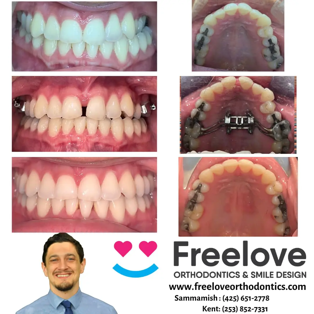 Before and after orthodontic treatment with a palate expander at Freelove Orthodontics in Sammamish or Kent, WA. Close-up images show dental alignment improvements and a palate expander in place.