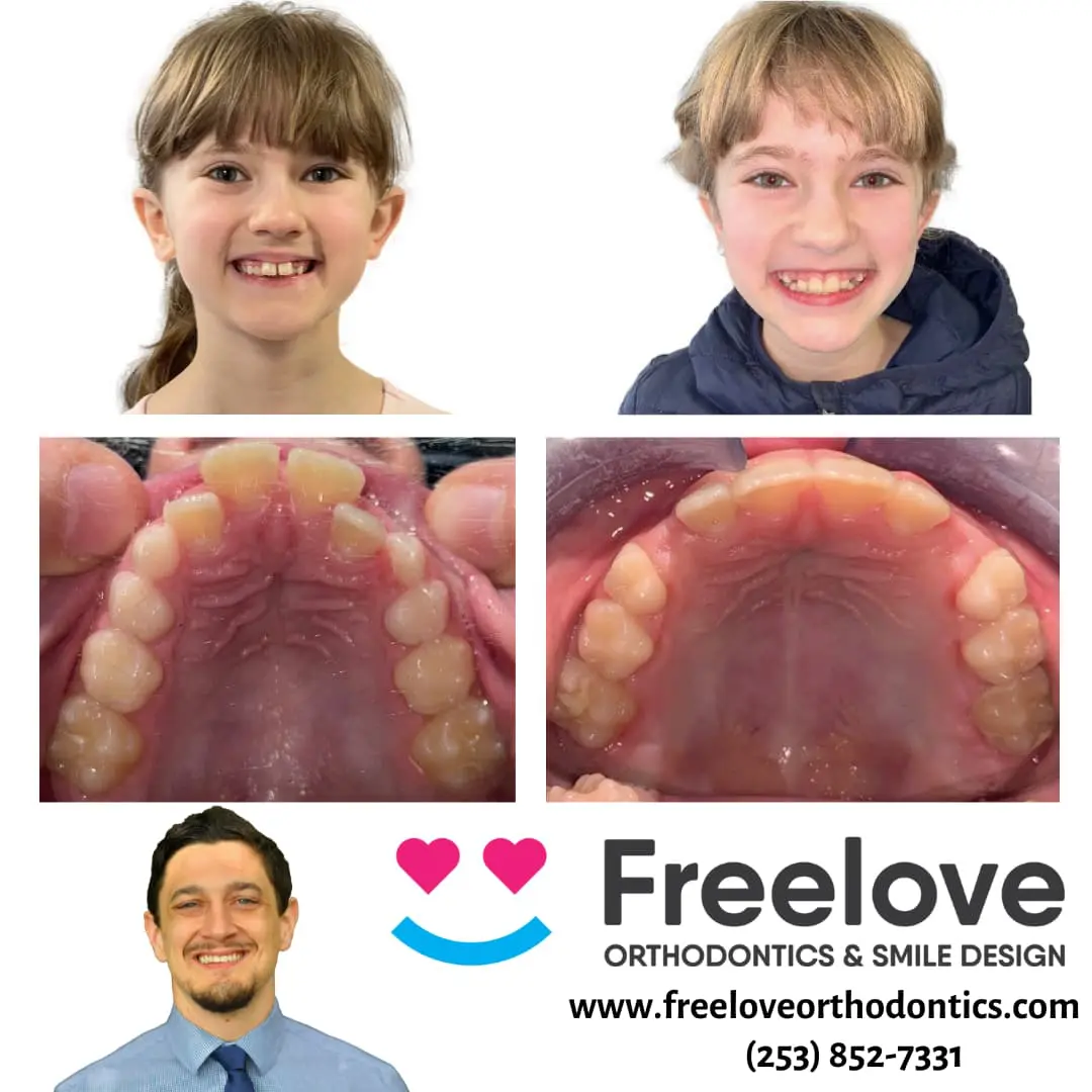 Young patient before and after treatment with a palate expander at Freelove Orthodontics in Sammamish or Kent, WA. Images show improved dental arch expansion and smiling transformation