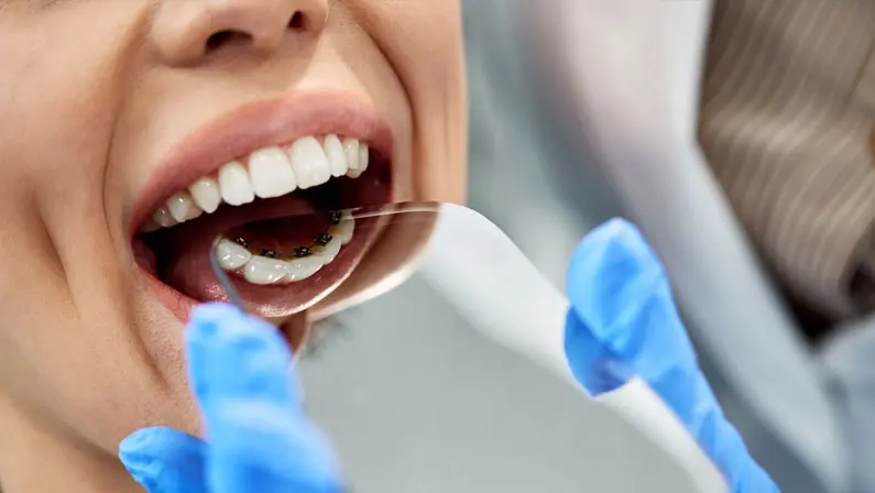 Close-up of a person with braces having their teeth examined by someone wearing blue gloves, using a dental mirror. Illustrating adult bracesin Sammamish and Kent, WA