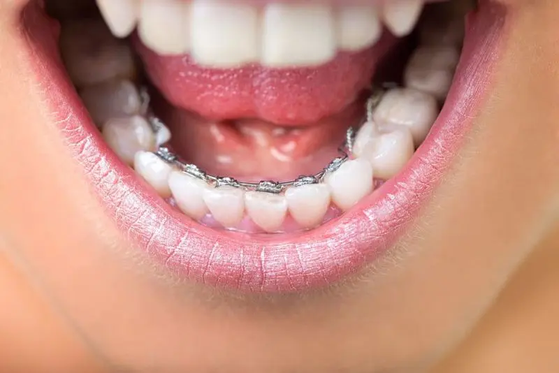 A close-up of a person’s mouth showing teeth with lingual braces on the lower set, against a backdrop of lips and a slightly open mouth. Illustrating Types of Braces in Kent or Sammamish, WA