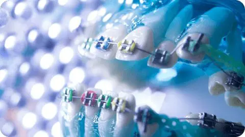 Close-up of a dental model with multicolored Metal Braces in Kent Sammamish, WA on teeth, against a blurry background of circular lights.
