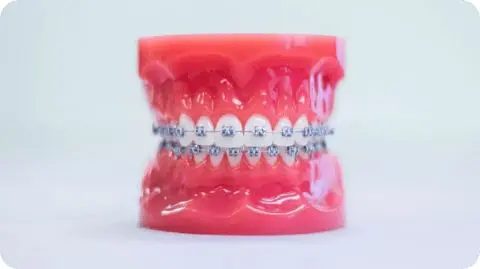 A dental model displaying teeth with metal braces in Kent Sammamish, WA on both upper and lower sets, set against a neutral background.