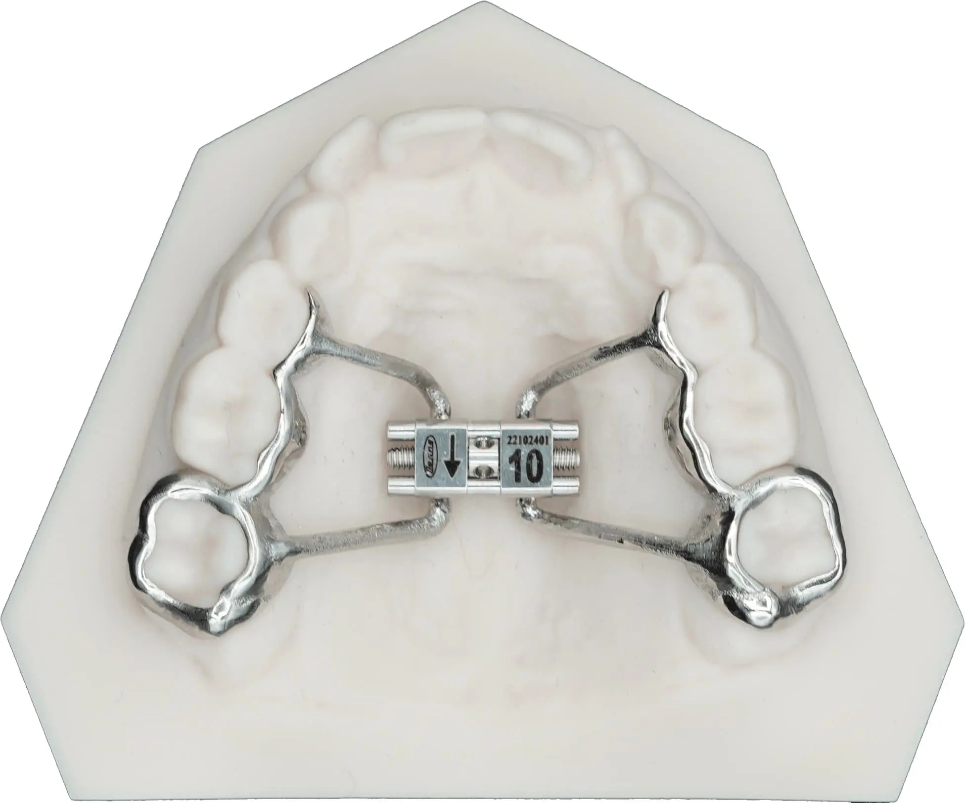 Dental mold showing an orthodontic palate expander from orthodontist in Sammamish or Kent, WA fitted on a model of the upper jaw, with metal components and screws visible.