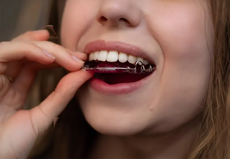 A person inserting a red teeth retainer replacement from orthodontist in Kent and Sammamish, WA into their mouth.